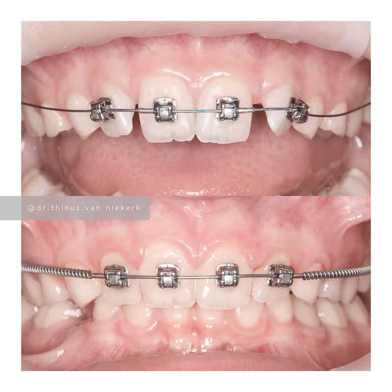 Damon® Braces In Umhlanga Dr Thinus Van Nierkerk Love Your Smile!